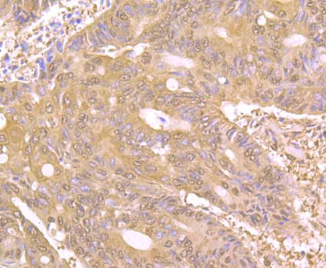 Immunohistochemical analysis of paraffin-embedded human colon cancer tissue using anti-PAK2 antibody. Counter stained with hematoxylin.