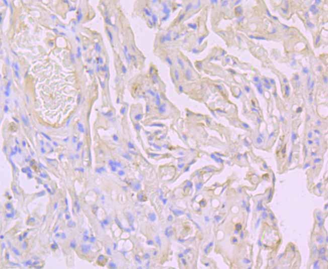 Immunohistochemical analysis of paraffin-embedded human lung cancer tissue using anti-Flotillin 1 antibody. Counter stained with hematoxylin.