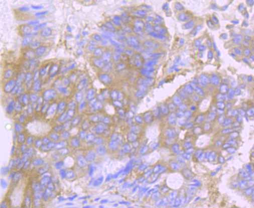 Immunohistochemical analysis of paraffin-embedded human colon cancer tissue using anti-DSG1 antibody. Counter stained with hematoxylin.