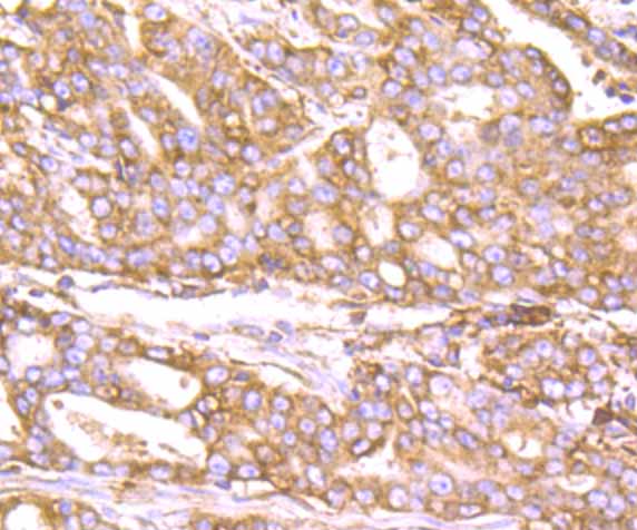 Immunohistochemical analysis of paraffin-embedded human stomach carcinoma tissue using anti-KDEL antibody. The section was pre-treated using heat mediated antigen retrieval with Tris-EDTA buffer (pH 8.0-8.4) for 20 minutes.The tissues were blocked in 5% BSA for 30 minutes at room temperature, washed with ddH2O and PBS, and then probed with the primary antibody (ET7107-86, 1/50) for 30 minutes at room temperature. The detection was performed using an HRP conjugated compact polymer system. DAB was used as the chromogen. Tissues were counterstained with hematoxylin and mounted with DPX.