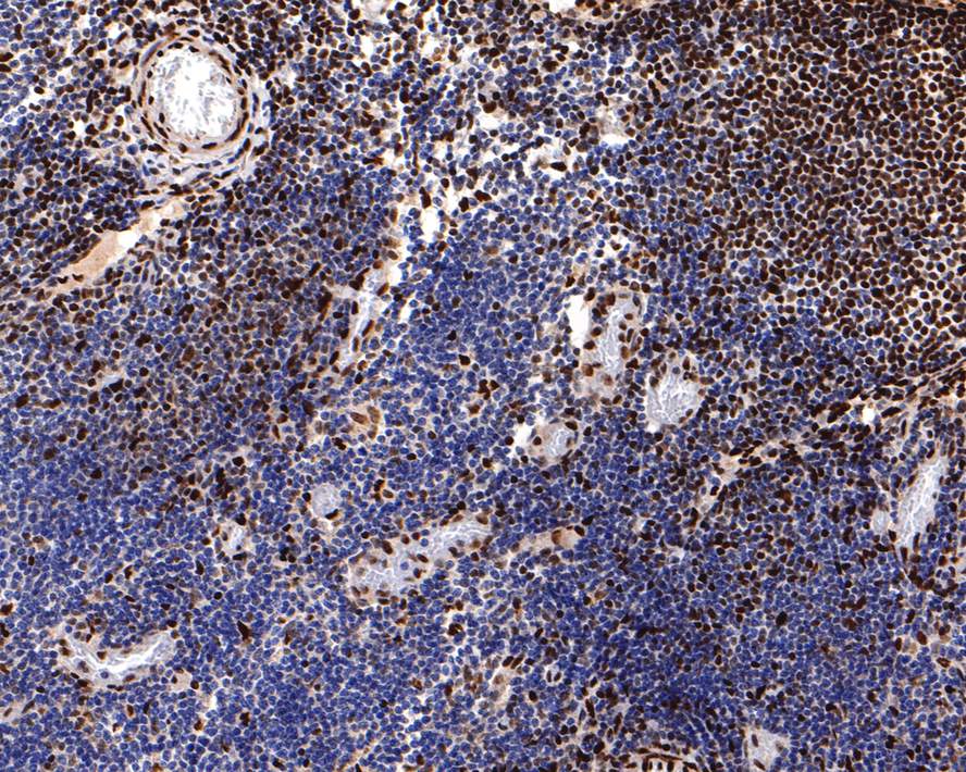 Immunohistochemical analysis of paraffin-embedded human lymph nodes tissue with Rabbit anti-Phospho-Creb (S133) antibody (ET7107-93) at 1/400 dilution.<br />
<br />
The section was pre-treated using heat mediated antigen retrieval with sodium citrate buffer (pH 6.0) for 2 minutes. The tissues were blocked in 1% BSA for 20 minutes at room temperature, washed with ddH2O and PBS, and then probed with the primary antibody (ET7107-93) at 1/400 dilution for 1 hour at room temperature. The detection was performed using an HRP conjugated compact polymer system. DAB was used as the chromogen. Tissues were counterstained with hematoxylin and mounted with DPX.