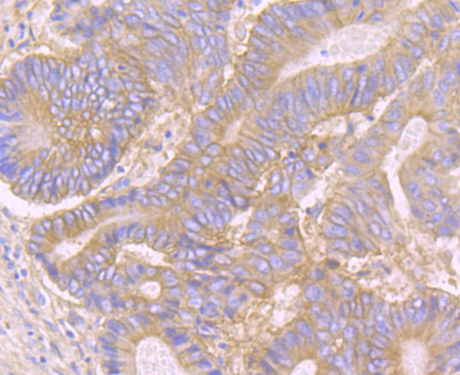 Immunohistochemical analysis of paraffin-embedded human colon carcinoma tissue using anti-CD46 antibody. The section was pre-treated using heat mediated antigen retrieval with Tris-EDTA buffer (pH 9.0) for 20 minutes.The tissues were blocked in 1% BSA for 30 minutes at room temperature, washed with ddH2O and PBS, and then probed with the primary antibody (ET7107-94, 1/50) for 30 minutes at room temperature. The detection was performed using an HRP conjugated compact polymer system. DAB was used as the chromogen. Tissues were counterstained with hematoxylin and mounted with DPX.