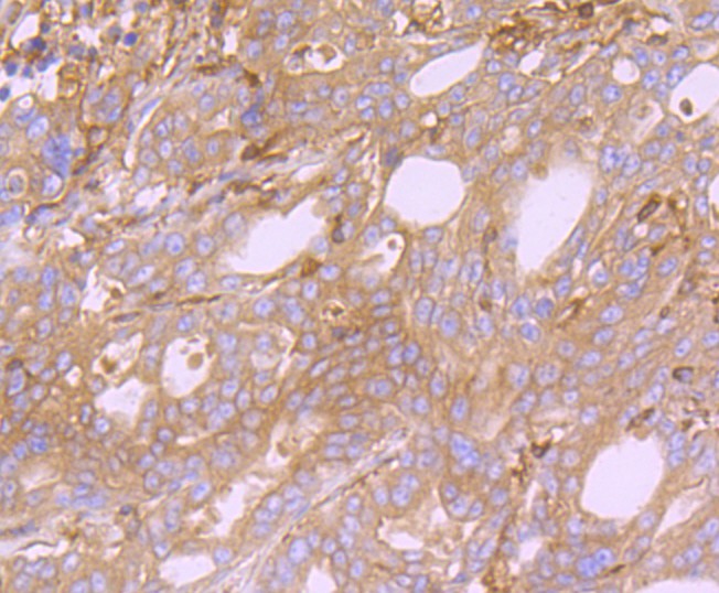 Immunohistochemical analysis of paraffin-embedded human stomach cancer tissue using anti-Arp3 antibody. Counter stained with hematoxylin.