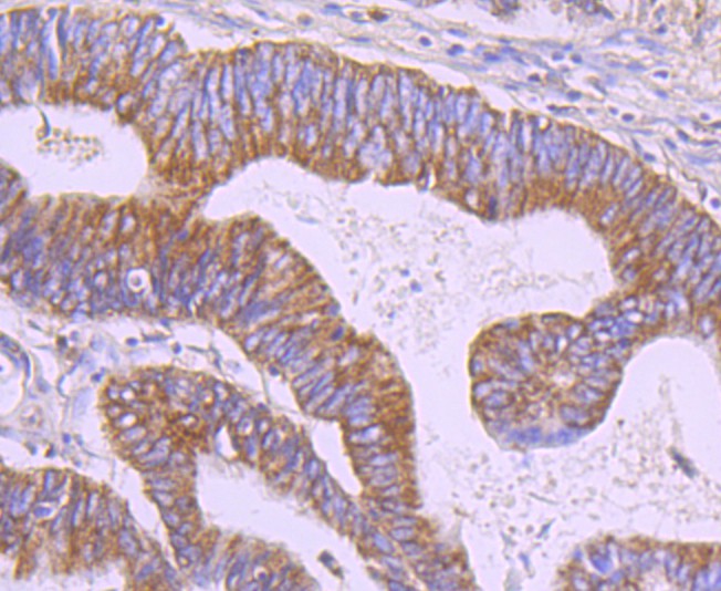Immunohistochemical analysis of paraffin-embedded human colon cancer tissue using anti-ERp29 antibody. Counter stained with hematoxylin.