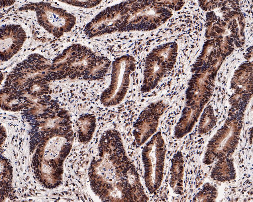 Immunohistochemical analysis of paraffin-embedded human colon carcinoma tissue with Rabbit anti-eIF4A3 antibody (ET7108-11) at 1/800 dilution.<br />
<br />
The section was pre-treated using heat mediated antigen retrieval with sodium citrate buffer (pH 6.0) for 2 minutes. The tissues were blocked in 1% BSA for 20 minutes at room temperature, washed with ddH2O and PBS, and then probed with the primary antibody (ET7108-11) at 1/800 dilution for 1 hour at room temperature. The detection was performed using an HRP conjugated compact polymer system. DAB was used as the chromogen. Tissues were counterstained with hematoxylin and mounted with DPX.