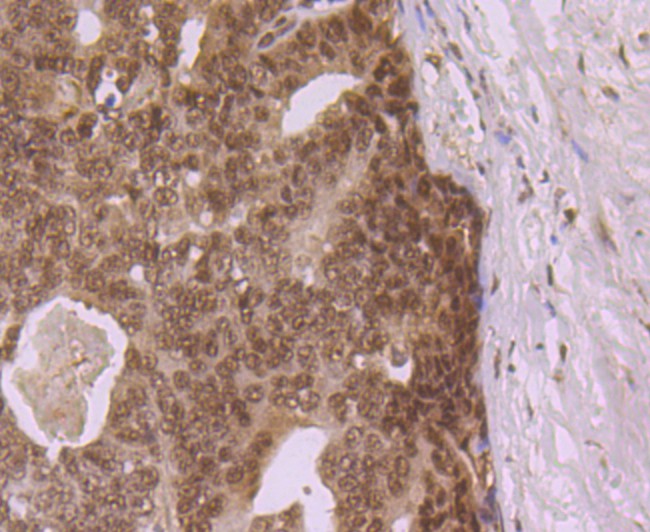 Immunohistochemical analysis of paraffin-embedded human prostate cancer tissue using anti-eIF4A3 antibody. Counter stained with hematoxylin.