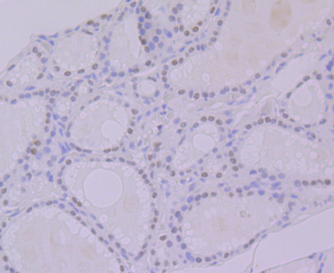 Immunohistochemical analysis of paraffin-embedded human thyroid tissue using anti-hnRNP Q antibody. The section was pre-treated using heat mediated antigen retrieval with Tris-EDTA buffer (pH 9.0) for 20 minutes.The tissues were blocked in 1% BSA for 30 minutes at room temperature, washed with ddH2O and PBS, and then probed with the primary antibody (ET7108-17, 1/50) for 30 minutes at room temperature. The detection was performed using an HRP conjugated compact polymer system. DAB was used as the chromogen. Tissues were counterstained with hematoxylin and mounted with DPX.