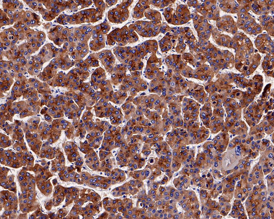 Immunohistochemical analysis of paraffin-embedded human liver carcinoma tissue with Rabbit anti-Transferrin Receptor 2 antibody (ET7108-21) at 1/1,000 dilution.<br />
<br />
The section was pre-treated using heat mediated antigen retrieval with Tris-EDTA buffer (pH 9.0) for 20 minutes. The tissues were blocked in 1% BSA for 20 minutes at room temperature, washed with ddH2O and PBS, and then probed with the primary antibody (ET7108-21) at 1/1,000 dilution for 1 hour at room temperature. The detection was performed using an HRP conjugated compact polymer system. DAB was used as the chromogen. Tissues were counterstained with hematoxylin and mounted with DPX.