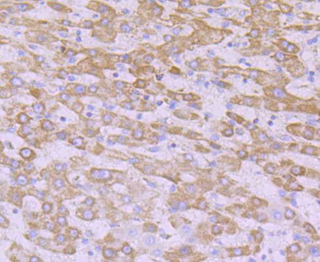Immunohistochemical analysis of paraffin-embedded  human liver carcinoma tissue with Rabbit anti-NDUFB8 antibody (ET7108-25) at 1/50 dilution.<br />
<br />
The section was pre-treated using heat mediated antigen retrieval with Tris-EDTA buffer (pH 8.0-8.4)) for 20 minutes. The tissues were blocked in 1% BSA for 20 minutes at room temperature, washed with ddH2O and PBS, and then probed with the primary antibody (ET7108-25) at 1/50 dilution for 0.5 hour at room temperature. The detection was performed using an HRP conjugated compact polymer system. DAB was used as the chromogen. Tissues were counterstained with hematoxylin and mounted with DPX.