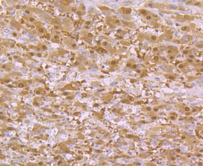 Immunohistochemical analysis of paraffin-embedded human liver carcinoma tissue with Rabbit anti-SULT2A1 antibody (ET7108-26) at 1/50 dilution.<br />
<br />
The section was pre-treated using heat mediated antigen retrieval with Tris-EDTA buffer (pH 8.0-8.4)) for 20 minutes. The tissues were blocked in 1% BSA for 20 minutes at room temperature, washed with ddH2O and PBS, and then probed with the primary antibody (ET7108-26) at 1/50 dilution for 0.5 hour at room temperature. The detection was performed using an HRP conjugated compact polymer system. DAB was used as the chromogen. Tissues were counterstained with hematoxylin and mounted with DPX.