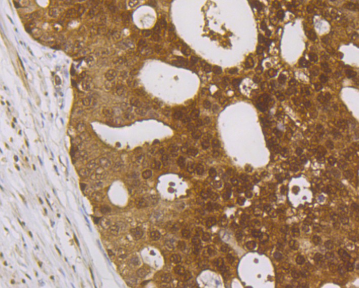 Immunohistochemical analysis of paraffin-embedded human prostate carcinoma tissue with Rabbit anti-IRAK2 antibody (ET7108-29) at 1/50 dilution.<br />
<br />
The section was pre-treated using heat mediated antigen retrieval with Tris-EDTA buffer (pH 9.0) for 20 minutes. The tissues were blocked in 1% BSA for 20 minutes at room temperature, washed with ddH2O and PBS, and then probed with the primary antibody (ET7108-29) at 1/50 dilution for 0.5 hour at room temperature. The detection was performed using an HRP conjugated compact polymer system. DAB was used as the chromogen. Tissues were counterstained with hematoxylin and mounted with DPX.