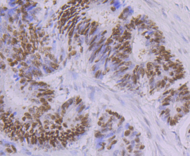 Immunohistochemical analysis of paraffin-embedded human colon cancer tissue with Rabbit anti-Oct-1 antibody (ET7108-30) at 1/50 dilution.<br />
<br />
The section was pre-treated using heat mediated antigen retrieval with sodium citrate buffer (pH 6.0) for 2 minutes. The tissues were blocked in 1% BSA for 20 minutes at room temperature, washed with ddH2O and PBS, and then probed with the primary antibody (ET7108-30) at 1/50 dilution for 1 hour at room temperature. The detection was performed using an HRP conjugated compact polymer system. DAB was used as the chromogen. Tissues were counterstained with hematoxylin and mounted with DPX.