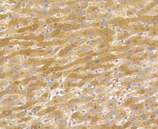 Immunohistochemical analysis of paraffin-embedded  human liver carcinoma tissue with Rabbit anti-Tetranectin antibody (ET7108-45) at 1/50 dilution.<br />
<br />
The section was pre-treated using heat mediated antigen retrieval with Tris-EDTA buffer (pH 9.0) for 20 minutes. The tissues were blocked in 1% BSA for 20 minutes at room temperature, washed with ddH2O and PBS, and then probed with the primary antibody (ET7108-45) at 1/50 dilution for 0.5 hour at room temperature. The detection was performed using an HRP conjugated compact polymer system. DAB was used as the chromogen. Tissues were counterstained with hematoxylin and mounted with DPX.