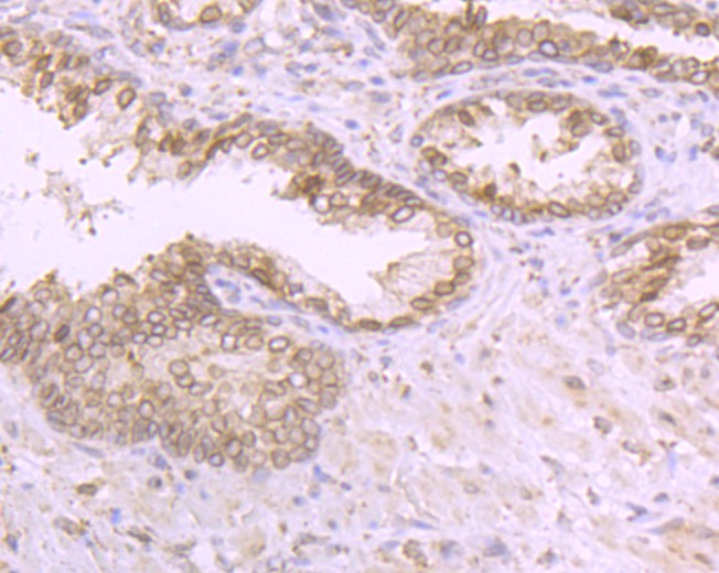 Immunohistochemical analysis of paraffin-embedded human prostate tissue with Rabbit anti-RanGAP1 antibody (ET7108-48) at 1/50 dilution.<br />
<br />
The section was pre-treated using heat mediated antigen retrieval with Tris-EDTA buffer (pH 8.0-8.4) for 20 minutes. The tissues were blocked in 1% BSA for 20 minutes at room temperature, washed with ddH2O and PBS, and then probed with the primary antibody (ET7108-48) at 1/50 dilution for 0.5 hour at room temperature. The detection was performed using an HRP conjugated compact polymer system. DAB was used as the chromogen. Tissues were counterstained with hematoxylin and mounted with DPX.