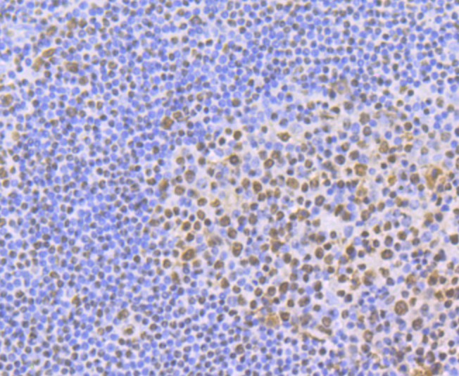 Immunohistochemical analysis of paraffin-embedded human tonsil tissue with Rabbit anti-ILF3 antibody (ET7108-49) at 1/50 dilution.<br />
<br />
The section was pre-treated using heat mediated antigen retrieval with Tris-EDTA buffer (pH 9.0) for 20 minutes. The tissues were blocked in 1% BSA for 20 minutes at room temperature, washed with ddH2O and PBS, and then probed with the primary antibody (ET7108-49) at 1/50 dilution for 0.5 hour at room temperature. The detection was performed using an HRP conjugated compact polymer system. DAB was used as the chromogen. Tissues were counterstained with hematoxylin and mounted with DPX.