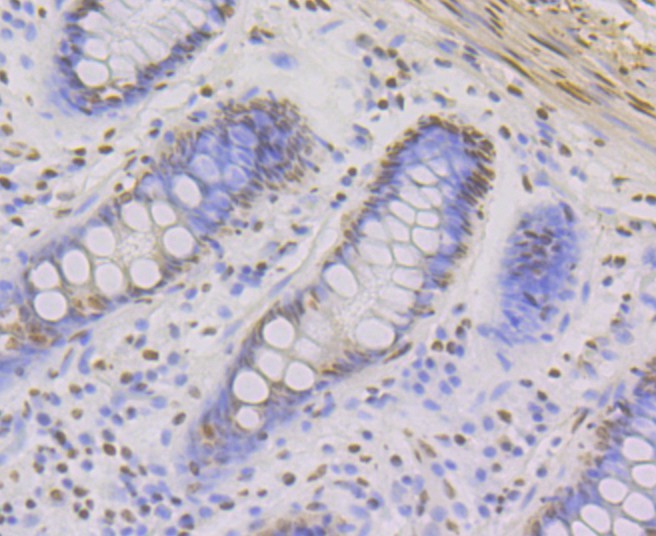 Immunohistochemical analysis of paraffin-embedded human colon tissue with Rabbit anti-ILF3 antibody (ET7108-49) at 1/50 dilution.<br />
<br />
The section was pre-treated using heat mediated antigen retrieval with Tris-EDTA buffer (pH 9.0) for 20 minutes. The tissues were blocked in 1% BSA for 20 minutes at room temperature, washed with ddH2O and PBS, and then probed with the primary antibody (ET7108-49) at 1/50 dilution for 0.5 hour at room temperature. The detection was performed using an HRP conjugated compact polymer system. DAB was used as the chromogen. Tissues were counterstained with hematoxylin and mounted with DPX.