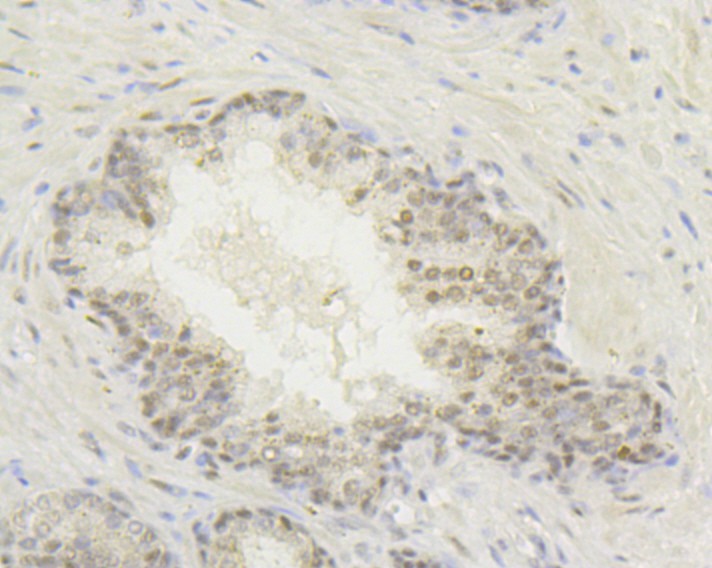 Immunohistochemical analysis of paraffin-embedded human prostate carcinoma tissue with Rabbit anti-HIF1AN antibody (ET7108-50) at 1/50 dilution.<br />
<br />
The section was pre-treated using heat mediated antigen retrieval with Tris-EDTA buffer (pH 9.0) for 20 minutes. The tissues were blocked in 1% BSA for 20 minutes at room temperature, washed with ddH2O and PBS, and then probed with the primary antibody (ET7108-50) at 1/50 dilution for 0.5 hour at room temperature. The detection was performed using an HRP conjugated compact polymer system. DAB was used as the chromogen. Tissues were counterstained with hematoxylin and mounted with DPX.