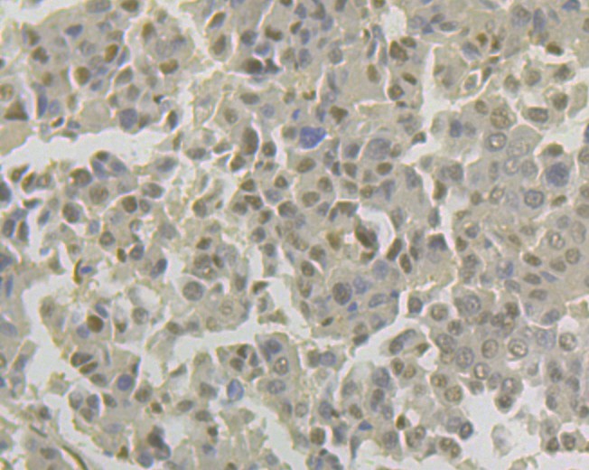 Immunohistochemical analysis of paraffin-embedded human liver carcinoma tissue with Rabbit anti-Lipin 1 antibody (ET7108-51) at 1/50 dilution.<br />
<br />
The section was pre-treated using heat mediated antigen retrieval with Tris-EDTA buffer (pH 8.0-8.4) for 20 minutes. The tissues were blocked in 1% BSA for 20 minutes at room temperature, washed with ddH2O and PBS, and then probed with the primary antibody (ET7108-51) at 1/50 dilution for 0.5 hour at room temperature. The detection was performed using an HRP conjugated compact polymer system. DAB was used as the chromogen. Tissues were counterstained with hematoxylin and mounted with DPX.