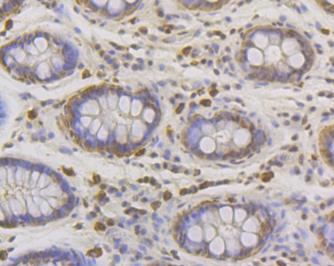 Immunohistochemical analysis of paraffin-embedded human colon tissue with Rabbit anti-Lipin 1 antibody (ET7108-51) at 1/50 dilution.<br />
<br />
The section was pre-treated using heat mediated antigen retrieval with Tris-EDTA buffer (pH 8.0-8.4) for 20 minutes. The tissues were blocked in 1% BSA for 20 minutes at room temperature, washed with ddH2O and PBS, and then probed with the primary antibody (ET7108-51) at 1/50 dilution for 0.5 hour at room temperature. The detection was performed using an HRP conjugated compact polymer system. DAB was used as the chromogen. Tissues were counterstained with hematoxylin and mounted with DPX.
