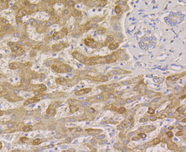 Immunohistochemical analysis of paraffin-embedded human liver cancer tissue using anti-PIST antibody. Counter stained with hematoxylin.