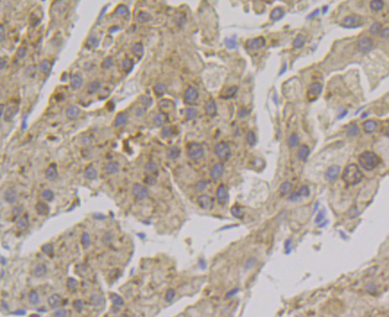 Immunohistochemical analysis of paraffin-embedded human liver tissue  with Rabbit anti-Alcohol Dehydrogenase antibody (ET7108-64) at 1/50 dilution.<br />
<br />
The section was pre-treated using heat mediated antigen retrieval with Tris-EDTA buffer (pH 8.0-8.4) for 20 minutes. The tissues were blocked in 1% BSA for 20 minutes at room temperature, washed with ddH2O and PBS, and then probed with the primary antibody (ET7108-64) at 1/50 dilution for 0.5 hour at room temperature. The detection was performed using an HRP conjugated compact polymer system. DAB was used as the chromogen. Tissues were counterstained with hematoxylin and mounted with DPX.