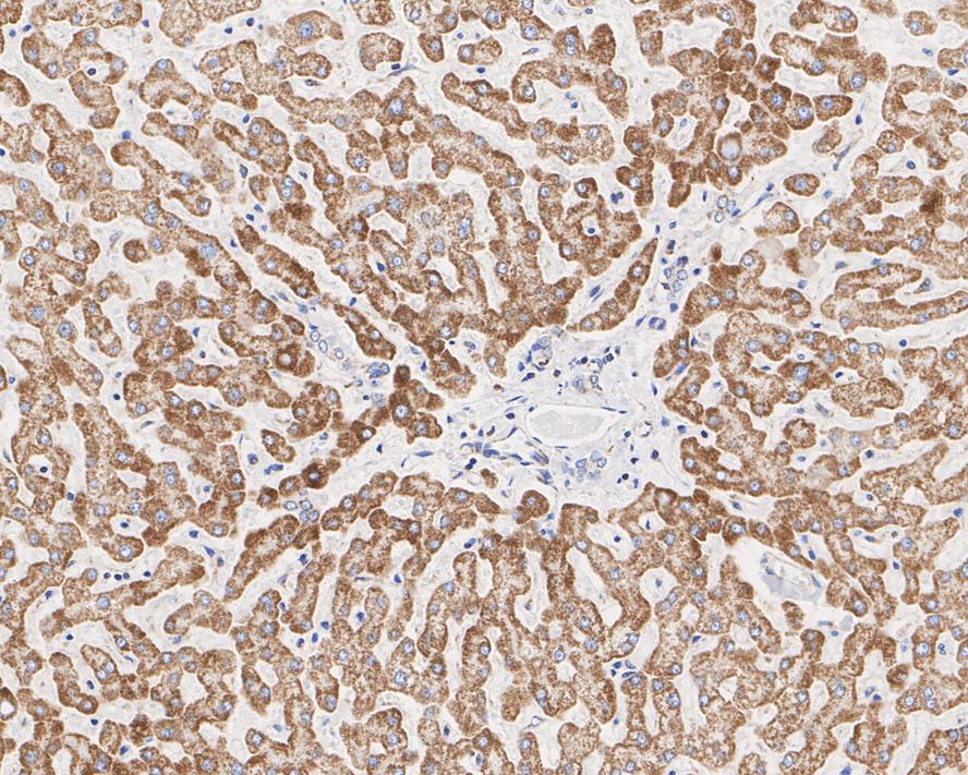Immunohistochemical analysis of paraffin-embedded human prostate cancer tissue using anti-GRIM19 antibody. Counter stained with hematoxylin.