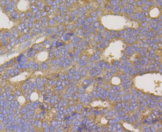 Immunohistochemical analysis of paraffin-embedded human prostate carcinoma tissue using anti-hUPF1 antibody. The section was pre-treated using heat mediated antigen retrieval with Tris-EDTA buffer (pH 8.0-8.4) for 20 minutes.The tissues were blocked in 5% BSA for 30 minutes at room temperature, washed with ddH2O and PBS, and then probed with the primary antibody (ET7108-70, 1/50) for 30 minutes at room temperature. The detection was performed using an HRP conjugated compact polymer system. DAB was used as the chromogen. Tissues were counterstained with hematoxylin and mounted with DPX.