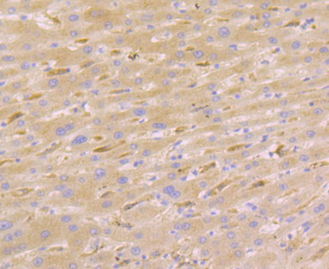 Immunohistochemical analysis of paraffin-embedded human liver cancer tissue with Rabbit anti-Nudel antibody (ET7108-73) at 1/50 dilution.<br />
<br />
The section was pre-treated using heat mediated antigen retrieval with Tris-EDTA buffer (pH 8.0-8.4) for 20 minutes. The tissues were blocked in 1% BSA for 20 minutes at room temperature, washed with ddH2O and PBS, and then probed with the primary antibody (ET7108-73) at 1/50 dilution for 1 hour at room temperature. The detection was performed using an HRP conjugated compact polymer system. DAB was used as the chromogen. Tissues were counterstained with hematoxylin and mounted with DPX.