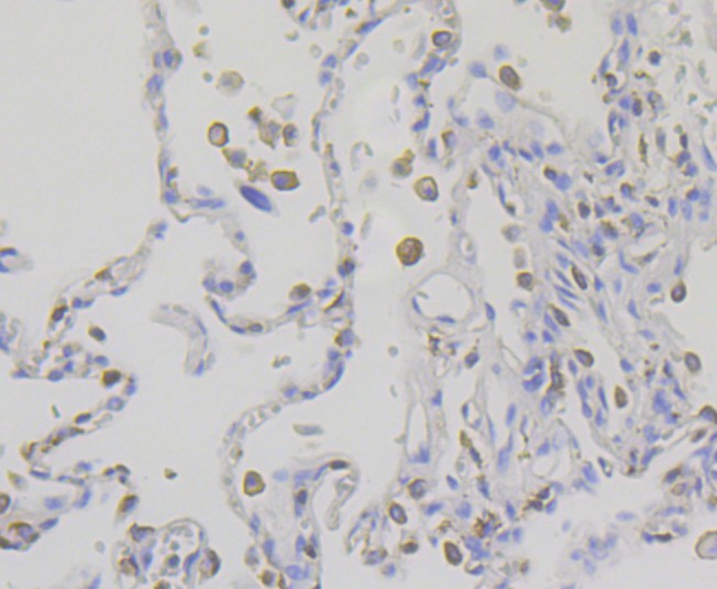 Immunohistochemical analysis of paraffin-embedded human lung carcinoma tissue using anti-IQGAP1 antibody. The section was pre-treated using heat mediated antigen retrieval with Tris-EDTA buffer (pH 9.0) for 20 minutes.The tissues were blocked in 1% BSA for 30 minutes at room temperature, washed with ddH2O and PBS, and then probed with the primary antibody (ET7108-79, 1/50) for 30 minutes at room temperature. The detection was performed using an HRP conjugated compact polymer system. DAB was used as the chromogen. Tissues were counterstained with hematoxylin and mounted with DPX.