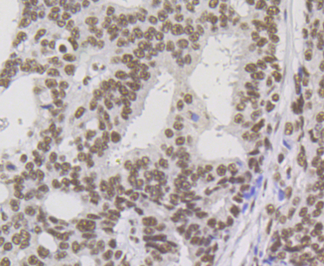 Immunohistochemical analysis of paraffin-embedded human prostate cancer tissue using anti-p54nrb antibody. Counter stained with hematoxylin.