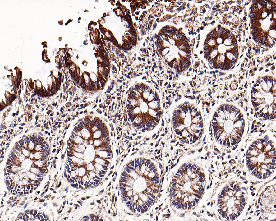 Immunohistochemical analysis of paraffin-embedded human colon tissue using anti-ADAMTS13 antibody. The section was pre-treated using heat mediated antigen retrieval with Tris-EDTA buffer (pH 8.0-8.4) for 20 minutes.The tissues were blocked in 5% BSA for 30 minutes at room temperature, washed with ddH2O and PBS, and then probed with the primary antibody (ET7108-86, 1/50) for 30 minutes at room temperature. The detection was performed using an HRP conjugated compact polymer system. DAB was used as the chromogen. Tissues were counterstained with hematoxylin and mounted with DPX.