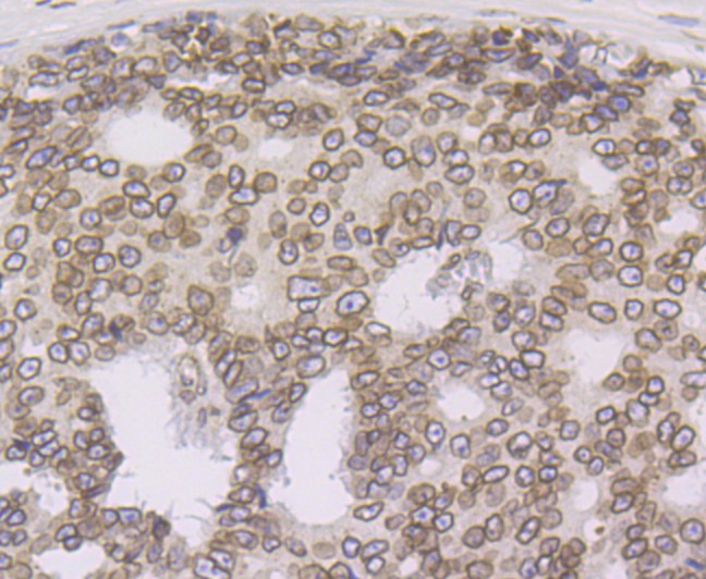 Immunohistochemical analysis of paraffin-embedded human prostate cancer tissue using anti-SUN2 antibody. Counter stained with hematoxylin.
