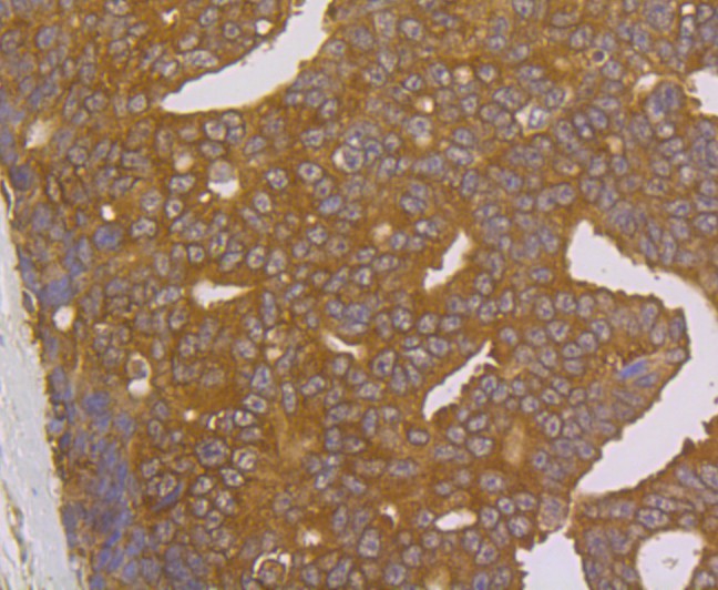 Immunohistochemical analysis of paraffin-embedded human prostate cancer tissue using anti-FKBP52 antibody. Counter stained with hematoxylin.