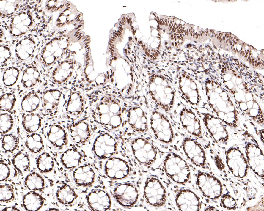Immunohistochemical analysis of paraffin-embedded human colon tissue using anti-CtBP1 antibody. The section was pre-treated using heat mediated antigen retrieval with sodium citrate buffer (pH 6.0) for 20 minutes. The tissues were blocked in 1% BSA for 30 minutes at room temperature, washed with ddH2O and PBS, and then probed with the primary antibody (ET7108-96, 1/400)  for 30 minutes at room temperature. The detection was performed using an HRP conjugated compact polymer system. DAB was used as the chromogen. Tissues were counterstained with hematoxylin and mounted with DPX.