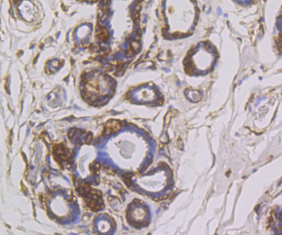 Immunohistochemical analysis of paraffin-embedded human breast carcinoma tissue using anti-SNX1 antibody. The section was pre-treated using heat mediated antigen retrieval with Tris-EDTA buffer (pH 9.0) for 20 minutes.The tissues were blocked in 1% BSA for 30 minutes at room temperature, washed with ddH2O and PBS, and then probed with the primary antibody (ET7109-02, 1/50) for 30 minutes at room temperature. The detection was performed using an HRP conjugated compact polymer system. DAB was used as the chromogen. Tissues were counterstained with hematoxylin and mounted with DPX.