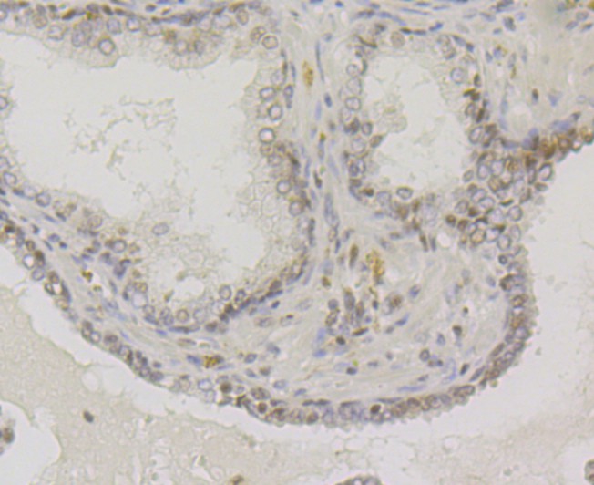 Immunohistochemical analysis of paraffin-embedded human prostate cancer tissue using anti-VAMP1 antibody. Counter stained with hematoxylin.