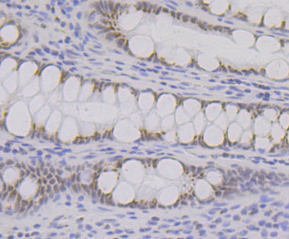 Immunohistochemical analysis of paraffin-embedded human colon tissue using anti-BRD2 antibody. The section was pre-treated using heat mediated antigen retrieval with Tris-EDTA buffer (pH 9.0) for 20 minutes.The tissues were blocked in 1% BSA for 30 minutes at room temperature, washed with ddH2O and PBS, and then probed with the primary antibody (ET7109-07, 1/50) for 30 minutes at room temperature. The detection was performed using an HRP conjugated compact polymer system. DAB was used as the chromogen. Tissues were counterstained with hematoxylin and mounted with DPX.