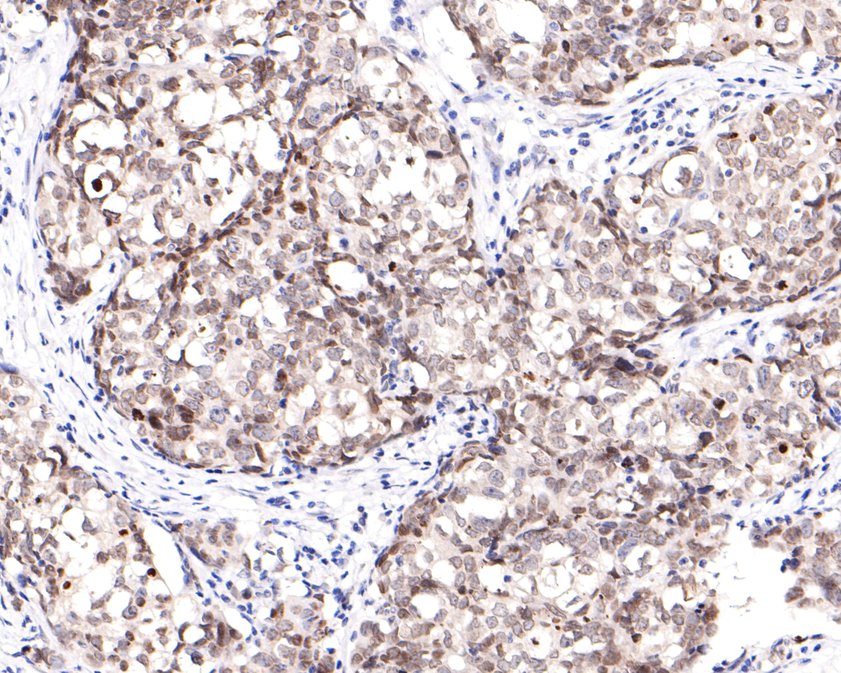 Immunohistochemical analysis of paraffin-embedded human breast carcinoma tissue using anti-BANF1 antibody. The section was pre-treated using heat mediated antigen retrieval with sodium citrate buffer (pH 6.0) for 20 minutes. The tissues were blocked in 1% BSA for 30 minutes at room temperature, washed with ddH2O and PBS, and then probed with the primary antibody (ET7109-08, 1/400)  for 30 minutes at room temperature. The detection was performed using an HRP conjugated compact polymer system. DAB was used as the chromogen. Tissues were counterstained with hematoxylin and mounted with DPX.