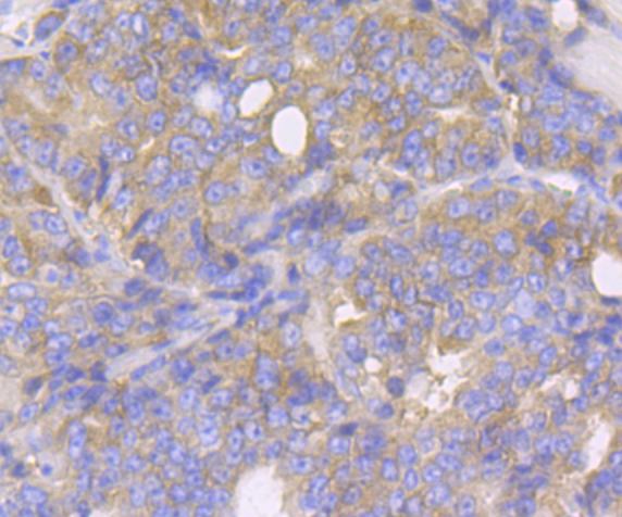 Immunohistochemical analysis of paraffin-embedded human prostate cancer tissue using anti-Lysyl tRNA synthetase antibody. Counter stained with hematoxylin.