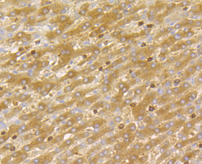 Immunohistochemical analysis of paraffin-embedded human liver cancer tissue using anti-DIAPH1 antibody. Counter stained with hematoxylin.