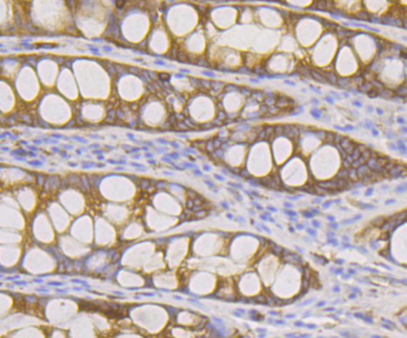 Immunohistochemical analysis of paraffin-embedded human colon tissue using anti-DIAPH1 antibody. Counter stained with hematoxylin.