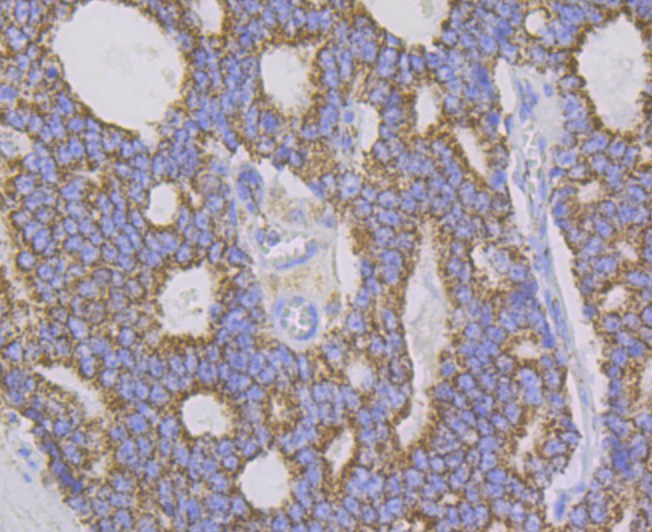 Immunohistochemical analysis of paraffin-embedded human prostate cancer tissue using anti-Aconitase 2 antibody. Counter stained with hematoxylin.