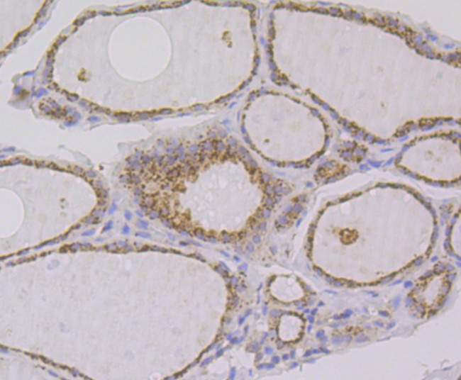 Immunohistochemical analysis of paraffin-embedded human thyroid tissue using anti-IMPDH2 antibody. The section was pre-treated using heat mediated antigen retrieval with Tris-EDTA buffer (pH 9.0) for 20 minutes.The tissues were blocked in 1% BSA for 30 minutes at room temperature, washed with ddH2O and PBS, and then probed with the primary antibody (ET7109-16, 1/50) for 30 minutes at room temperature. The detection was performed using an HRP conjugated compact polymer system. DAB was used as the chromogen. Tissues were counterstained with hematoxylin and mounted with DPX.