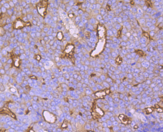 Immunohistochemical analysis of paraffin-embedded human prostate cancer tissue using anti-Syntaxin 3 antibody. Counter stained with hematoxylin.
