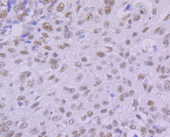 Immunohistochemical analysis of paraffin-embedded human lung carcinoma tissue using anti-KHSRP antibody. The section was pre-treated using heat mediated antigen retrieval with Tris-EDTA buffer (pH 9.0) for 20 minutes.The tissues were blocked in 1% BSA for 30 minutes at room temperature, washed with ddH2O and PBS, and then probed with the primary antibody (ET7109-30, 1/50) for 30 minutes at room temperature. The detection was performed using an HRP conjugated compact polymer system. DAB was used as the chromogen. Tissues were counterstained with hematoxylin and mounted with DPX.