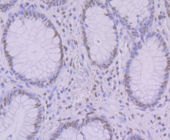 Immunohistochemical analysis of paraffin-embedded human colon tissue using anti-KHSRP antibody. The section was pre-treated using heat mediated antigen retrieval with Tris-EDTA buffer (pH 9.0) for 20 minutes.The tissues were blocked in 1% BSA for 30 minutes at room temperature, washed with ddH2O and PBS, and then probed with the primary antibody (ET7109-30, 1/50) for 30 minutes at room temperature. The detection was performed using an HRP conjugated compact polymer system. DAB was used as the chromogen. Tissues were counterstained with hematoxylin and mounted with DPX.