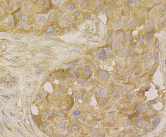 Immunohistochemical analysis of paraffin-embedded human breast cancer tissue using anti-MARK3 antibody. The section was pre-treated using heat mediated antigen retrieval with Tris-EDTA buffer (pH 8.0-8.4) for 20 minutes. The tissues were blocked in 5% BSA for 30 minutes at room temperature, washed with ddH2O and PBS, and then probed with the antibody (ET7109-39) at 1/100 dilution, for 30 minutes at room temperature and detected using an HRP conjugated compact polymer system. DAB was used as the chrogen. Counter stained with hematoxylin and mounted with DPX.