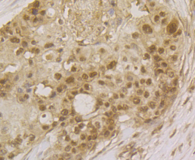 Immunohistochemical analysis of paraffin-embedded human breast cancer tissue using anti-SFRS3 antibody. The section was pre-treated using heat mediated antigen retrieval with Tris-EDTA buffer (pH 8.0-8.4) for 20 minutes. The tissues were blocked in 5% BSA for 30 minutes at room temperature, washed with ddH2O and PBS, and then probed with the antibody (ET7109-47) at 1/200 dilution, for 30 minutes at room temperature and detected using an HRP conjugated compact polymer system. DAB was used as the chrogen. Counter stained with hematoxylin and mounted with DPX.