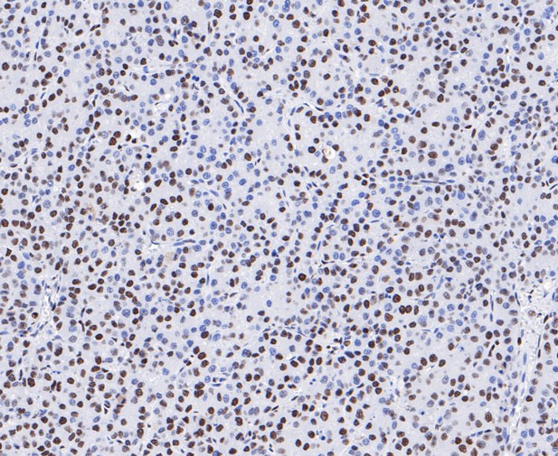Immunohistochemical analysis of paraffin-embedded human liver cancer tissue using anti-SAM68 antibody. The section was pre-treated using heat mediated antigen retrieval with sodium citrate buffer (pH 6.0) for 20 minutes. The tissues were blocked in 5% BSA for 30 minutes at room temperature, washed with ddH2O and PBS, and then probed with the primary antibody (ET7109-52, 1/1,000)  for 30 minutes at room temperature. The detection was performed using an HRP conjugated compact polymer system. DAB was used as the chromogen. Tissues were counterstained with hematoxylin and mounted with DPX.