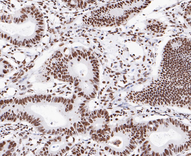 Immunohistochemical analysis of paraffin-embedded human colon cancer tissue using anti-SAM68 antibody. The section was pre-treated using heat mediated antigen retrieval with sodium citrate buffer (pH 6.0) for 20 minutes. The tissues were blocked in 5% BSA for 30 minutes at room temperature, washed with ddH2O and PBS, and then probed with the primary antibody (ET7109-52, 1/1,000)  for 30 minutes at room temperature. The detection was performed using an HRP conjugated compact polymer system. DAB was used as the chromogen. Tissues were counterstained with hematoxylin and mounted with DPX.